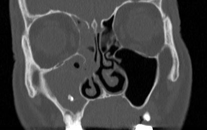 Aspergillose sinusienne