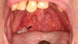 Carcinome épidermoïde de l'amygdale